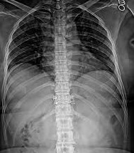 CERVICAL SPINE X-RAY AP/LAT